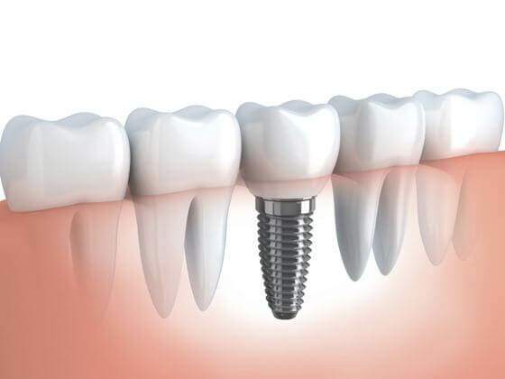 Implante Dentário |Mitos e Verdades que Precisa Saber