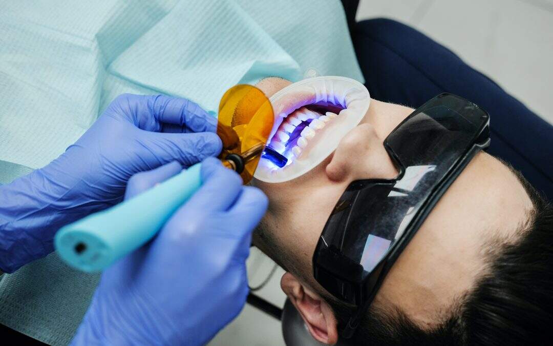 Clareamento dental | Esclarecendo todas as dúvidas sobre essa técnica
