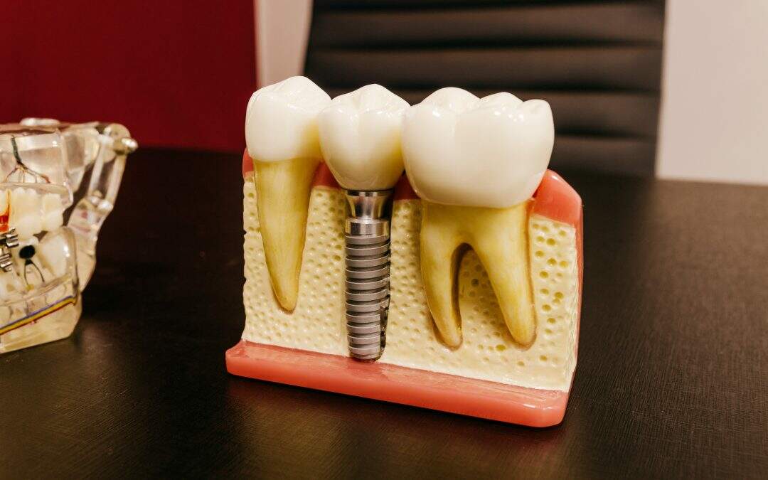 Implante dentário l Qualquer pessoa pode optar pelo procedimento?