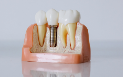 Cuidados essenciais após o implante dentário