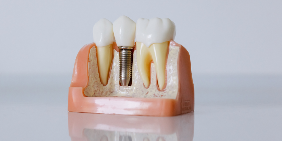 Cuidados essenciais após o implante dentário