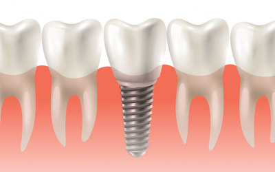 Quanto Tempo Dura o Implante Dentário?