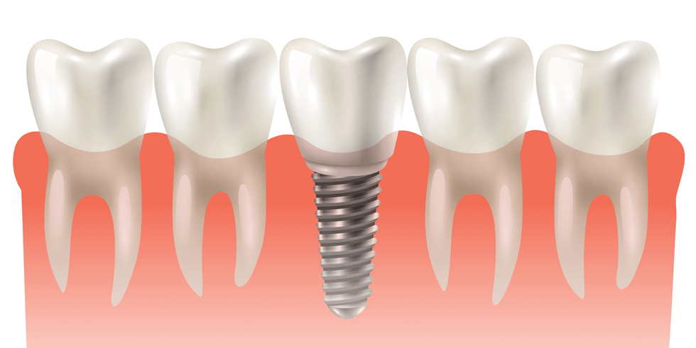 Quanto Tempo Dura o Implante Dentário?