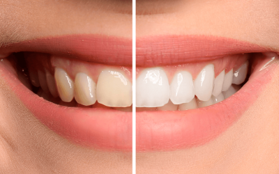 Clareamento Dental Enfraquece os Dentes?