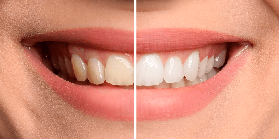 Clareamento Dental Enfraquece os Dentes?
