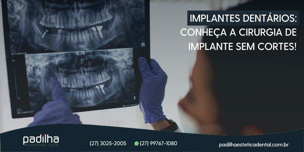 Implantes Dentários: Conheça a cirurgia de implante sem cortes!