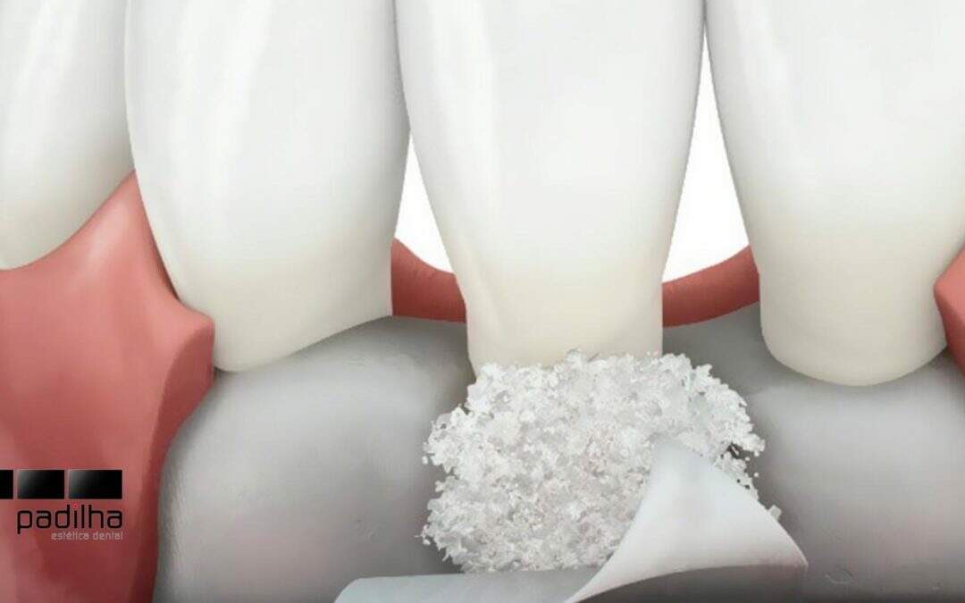 Implantes Dentários | Como funciona o enxerto ósseo?