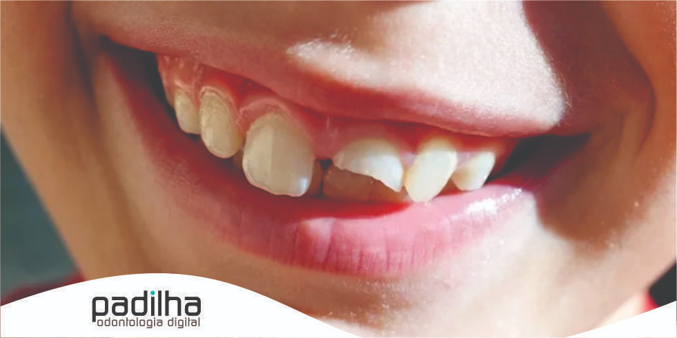 Tratamento para Dentes Quebrados: Conselhos para uma Saúde Bucal Ideal