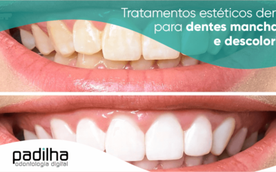 Tratamentos Estéticos Dentais Para Dentes Manchados e Descoloridos
