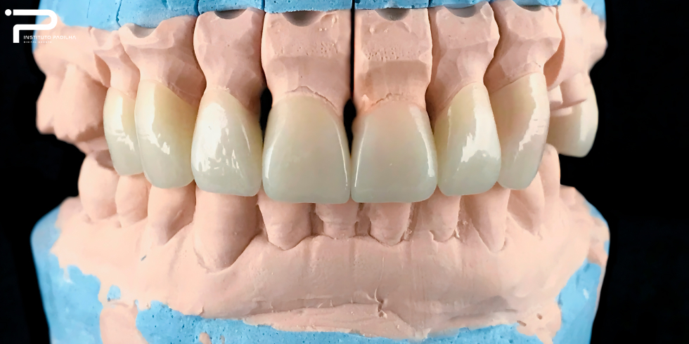 Implantação de Prótese Dentária: Conheça os Principais Tipos
