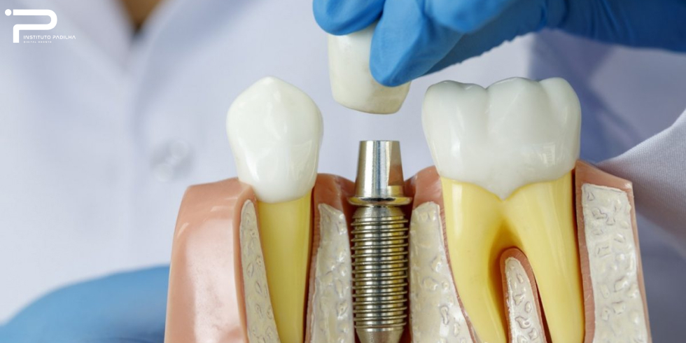 Implante e Prótese Dentária: Qual a Diferença?
