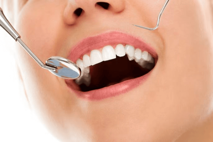 Como funciona a lente de contato nos dentes?